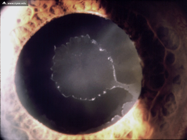 Pseudoexfoliation Glaucoma - NYEE